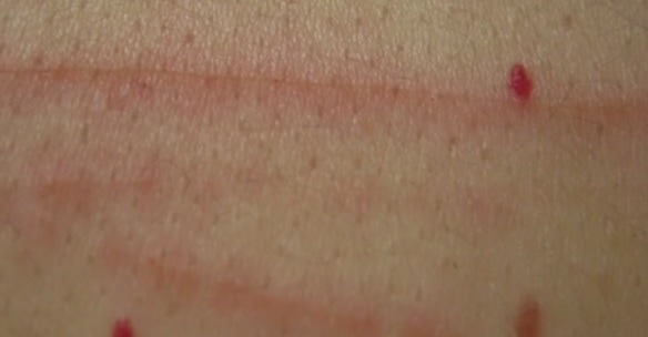 Angiomes Faut-il s’inquiéter de ces tâches rouges qui apparaissent sur votre peau